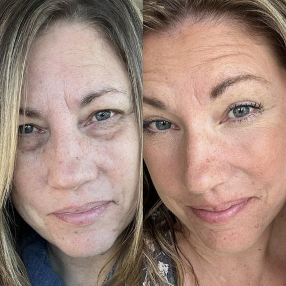 Klivora Revitalizing Under Eye Balm for Dark Circles, Puffiness & Fine Lines